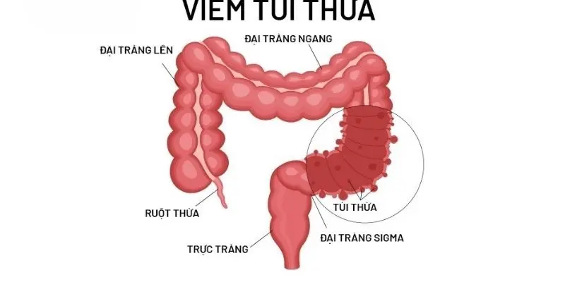 Viêm túi thừa - Triệu chứng thầm lặng cần nhận diện sớm