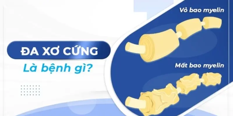 Bệnh đa xơ cứng là gì? Nguyên nhân và dấu hiệu nhận biết