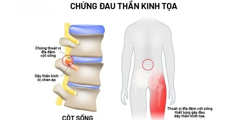 Tại sao đau dây thần kinh tọa gây đau lưng dữ dội?