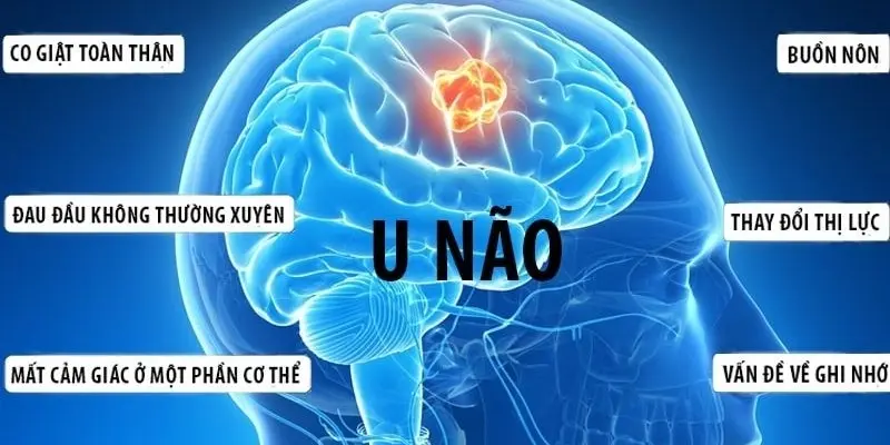 Những triệu chứng đầu tiên cảnh báo bệnh u não nguy hiểm