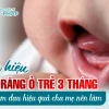 Dấu hiệu mọc răng ở trẻ 3 tháng tuổi và cách chăm sóc