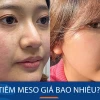 Tiêm Meso Giá Bao Nhiêu? Cẩm Nang Chi Tiết Từ A-Z Năm 2026