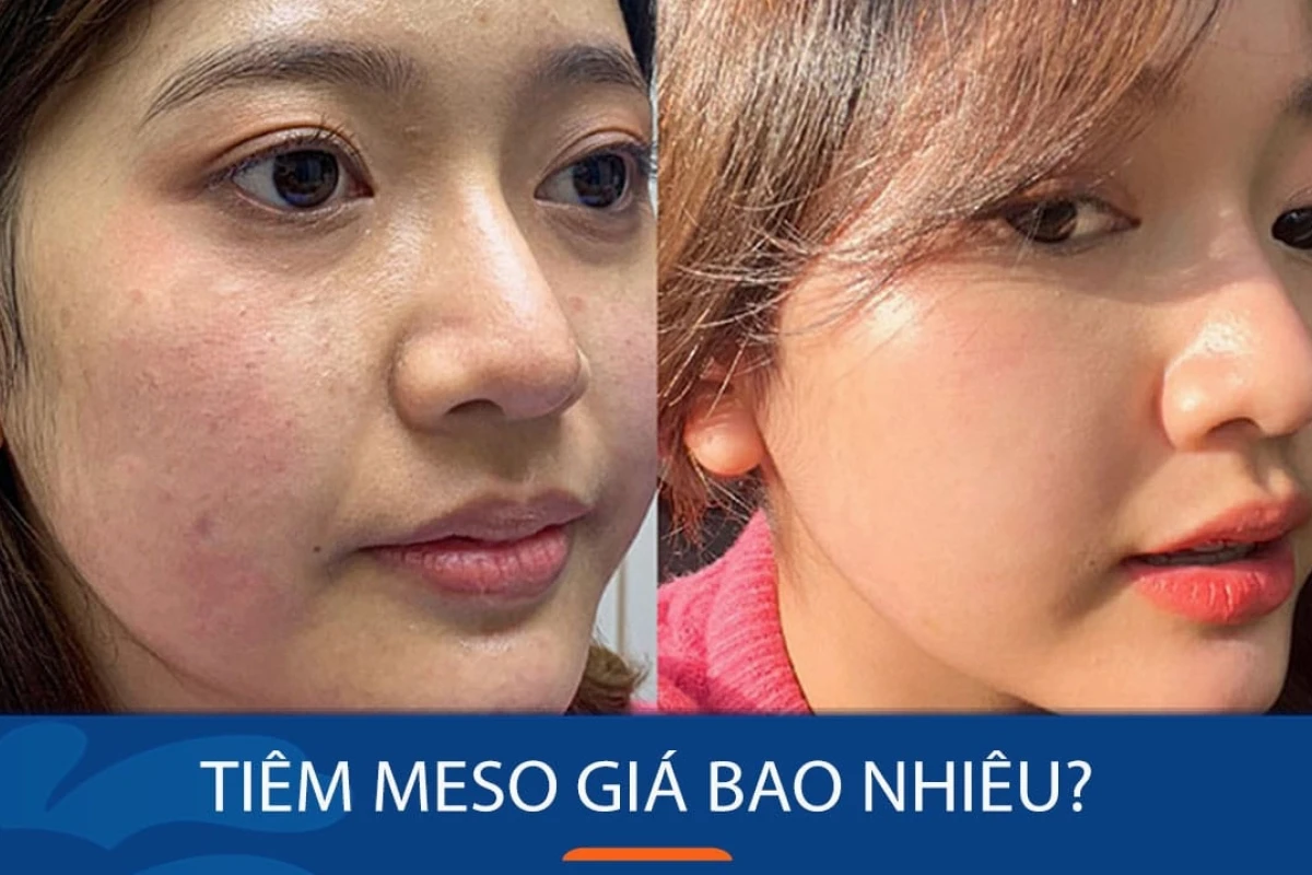 Tiêm Meso Giá Bao Nhiêu? Cẩm Nang Chi Tiết Từ A-Z Năm 2026