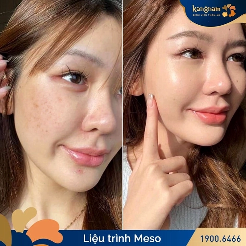 Kết quả da căng bóng và khỏe mạnh sau tiêm meso