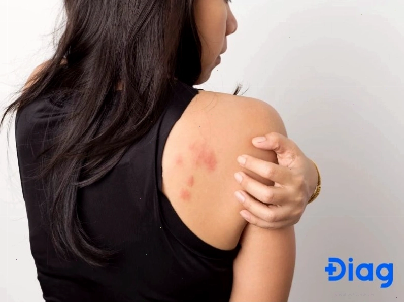 Ngứa da là một trong những dấu hiệu cho thấy cơ thể có thể bị nhiễm giun