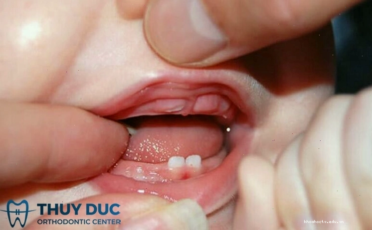 Thứ tự mọc răng ở trẻ