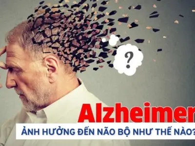 Bệnh Alzheimer ảnh hưởng đến não bộ ra sao?