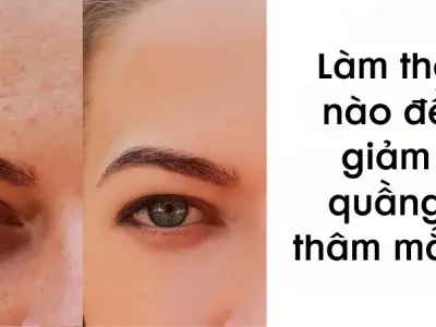 Làm thế nào để giảm quầng thâm mắt nhanh và hiệu quả?