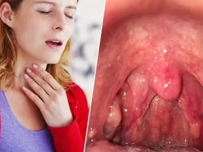 Viêm họng do nguyên nhân gì? Bác sĩ tiết lộ sự thật