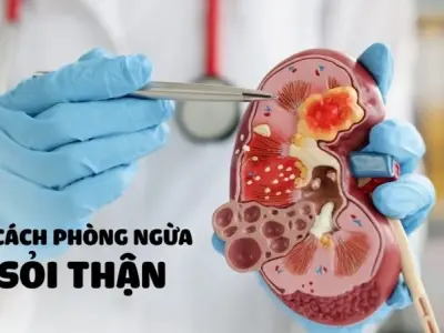 Triệu chứng của bệnh sỏi thận là gì? Đừng xem nhẹ