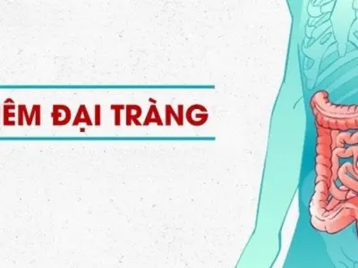 Triệu chứng của viêm đại tràng là gì? Dấu hiệu phổ biến