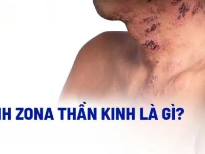 Zona thần kinh có triệu chứng gì và nhận biết ra sao?