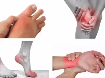 Triệu chứng của bệnh viêm khớp là gì và mức độ nguy hiểm