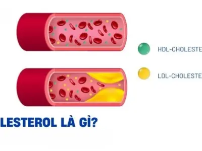 Làm thế nào để giảm cholesterol bằng chế độ ăn uống?