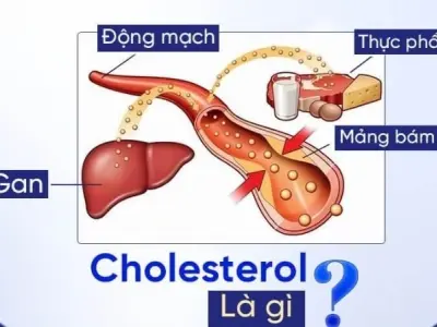 Cholesterol cao tác động gì đến hệ tim mạch con người?