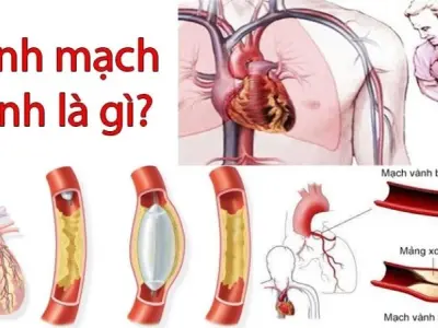 Bệnh mạch vành - Cách điều trị và phòng ngừa hiệu quả