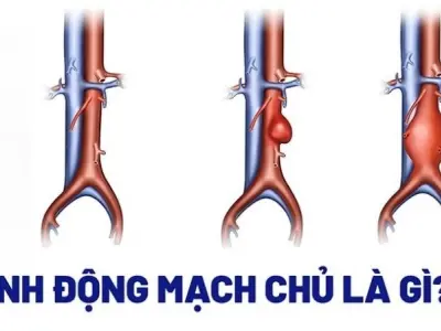 Triệu chứng cảnh báo phình động mạch chủ nguy hiểm
