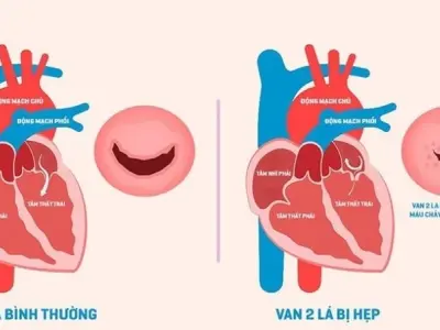 Các phương pháp điều trị van tim phổ biến hiện nay