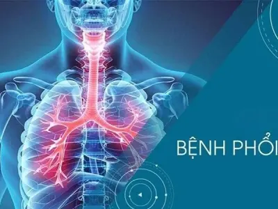 Điều trị bệnh phổi kẽ - Giải pháp nào là tối ưu nhất?