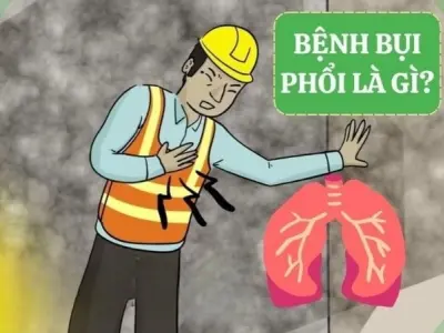 Triệu chứng của bệnh bụi phổi là gì và dấu hiệu cảnh báo