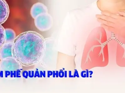 Làm thế nào để phòng ngừa viêm phế quản hiệu quả?