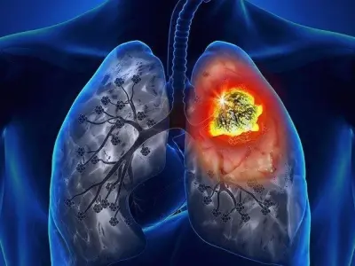 Triệu chứng ban đầu của ung thư phổi dễ bị bỏ qua