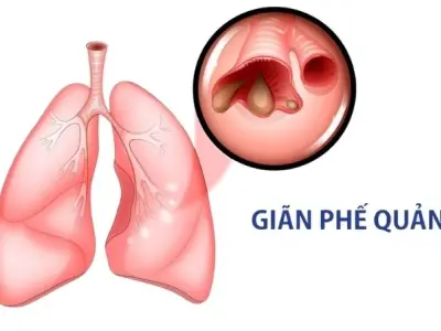 Triệu chứng của bệnh giãn phế quản nguy hiểm dễ bị bỏ qua