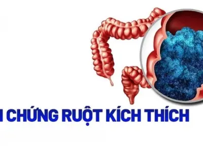 Triệu chứng của hội chứng ruột kích thích IBS là gì?
