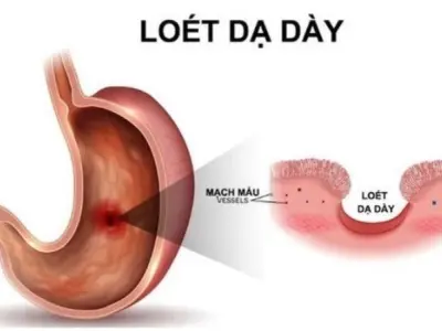 Làm sao để bảo vệ dạ dày khỏi tình trạng loét kéo dài?