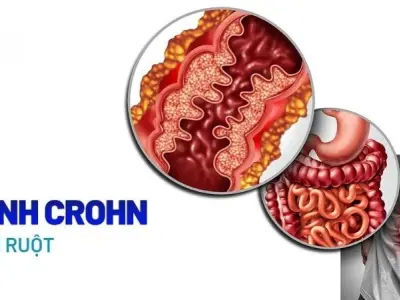 Bệnh Crohn được điều trị như thế nào và trong bao lâu?