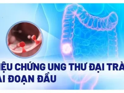 Triệu chứng ung thư đại tràng bạn không nên chủ quan