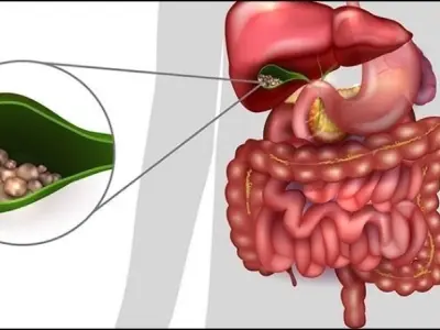 Thói quen nào giúp ngừa sỏi mật và bảo vệ hệ tiêu hóa?