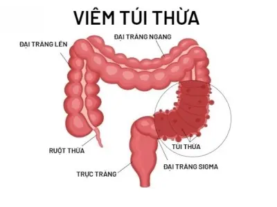 Viêm túi thừa - Triệu chứng thầm lặng cần nhận diện sớm