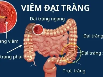 Triệu chứng của viêm loét đại tràng là gì? Dấu hiệu cảnh báo