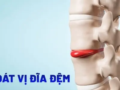 Triệu chứng của thoát vị đĩa đệm là gì và nguy hiểm thế nào