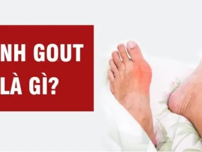 Bệnh gút do nguyên nhân gì? Cách điều trị và phòng ngừa