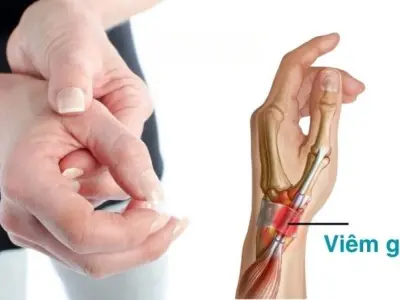 Triệu chứng của viêm gân là gì? Đừng bỏ qua dấu hiệu này