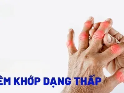 Bệnh viêm khớp dạng thấp được điều trị như thế nào?