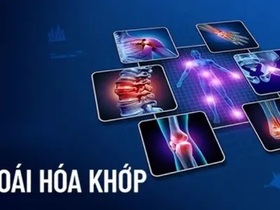 Thoái hóa khớp là gì? Nhận biết qua triệu chứng phổ biến