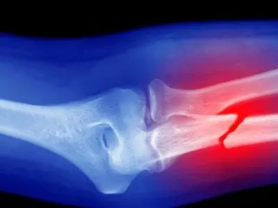 Triệu chứng của gãy xương là gì và cách xử lý kịp thời