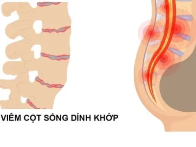 Tại sao bệnh viêm cột sống dính khớp khó điều trị?