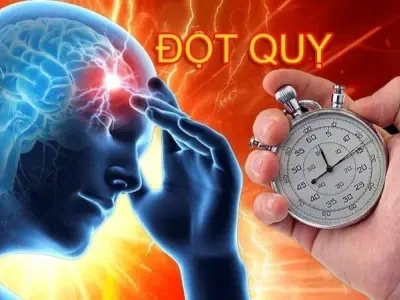 Tại sao đột quỵ thường xảy ra đột ngột và nguy hiểm?