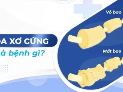 Bệnh đa xơ cứng là gì? Nguyên nhân và dấu hiệu nhận biết