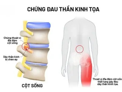 Tại sao đau dây thần kinh tọa gây đau lưng dữ dội?