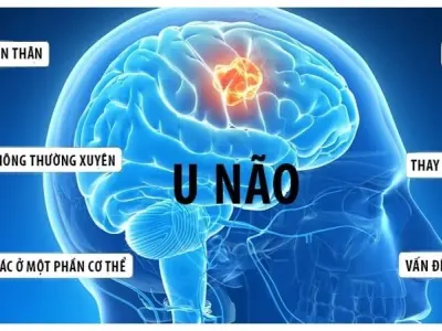 Những triệu chứng đầu tiên cảnh báo bệnh u não nguy hiểm