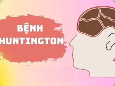 Giải mã nguyên nhân khiến Huntington khó điều trị