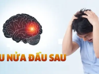 Làm thế nào để điều trị đau nửa đầu hiệu quả và an toàn?