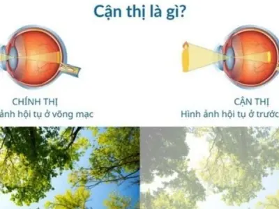 Tại sao cận thị ngày càng phổ biến ở giới trẻ hiện nay?