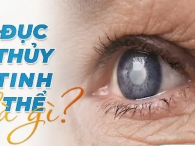 Làm thế nào để phòng ngừa đục thủy tinh thể hiệu quả?