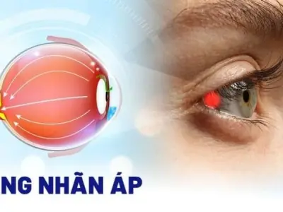 Tăng nhãn áp là gì? Triệu chứng cảnh báo cần lưu ý